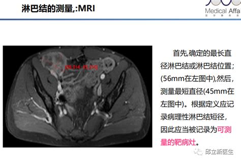 壹生资讯 实体瘤疗效评价标准全面解读！附实例！