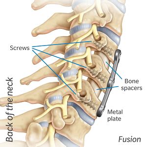 Mobi-C vs Fusion | Artificial Cervical Disc | Zimmer Biomet