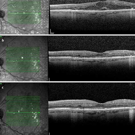 A Spectral Domain Optical Coherence Tomography Of The Macular Edema Download Scientific Diagram