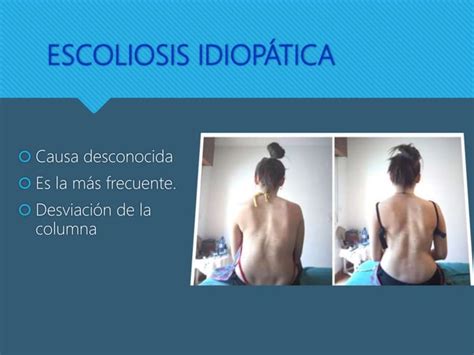 Escoliosis Causas Y Tratamientos Ppt