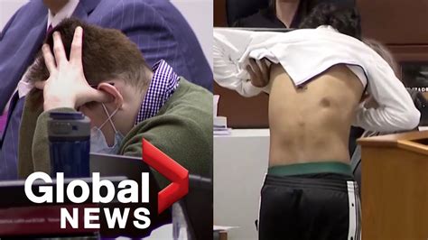 Nikolas Cruz Trial Parkland School Shooting Survivor Shows Scars From