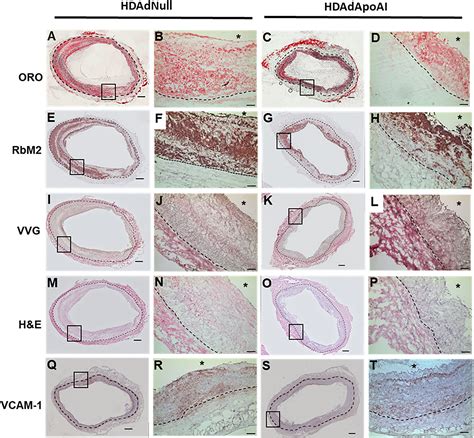 Apolipoprotein A I Vascular Gene Therapy Reduces Vein Graft