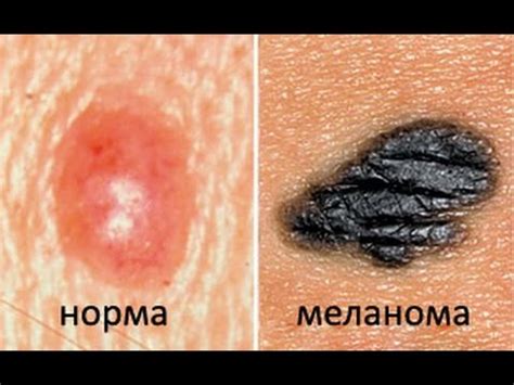 Как распространяются метастазы при раке (на примере меланомы)? - YouTube