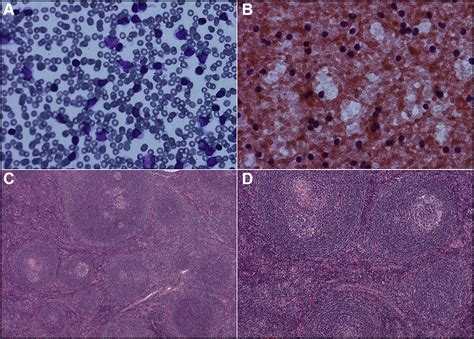 Castleman S Disease Presenting As A Mediastinal Mass Mimicker Of Malignancy The American