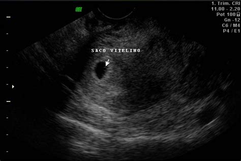 Ultrasonido En El Primer Trimestre Del Embarazo