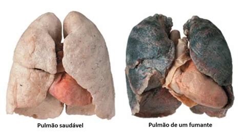 Veja como fica o pulmão de um fumante depois de 20 cigarros Segredos