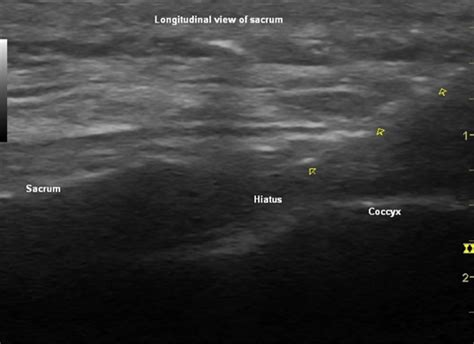 Ultrasound Guidance For Caudal Epidural Steroid Injection