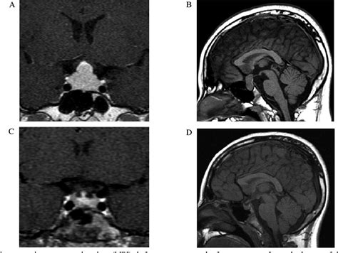 Figure 1 From Secondary Pituitary Hyperplasia Induced By Hashimotos Thyroiditis Related