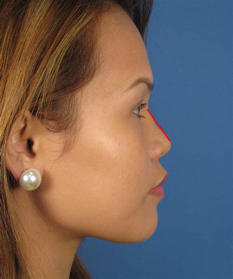 San Diego Asian Rhinoplasty Expert Dr John Hilinski Nose Reshaping