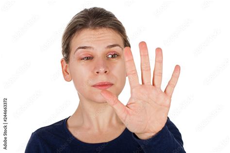 Chalazion Eyelid Infection Stock Photo Adobe Stock