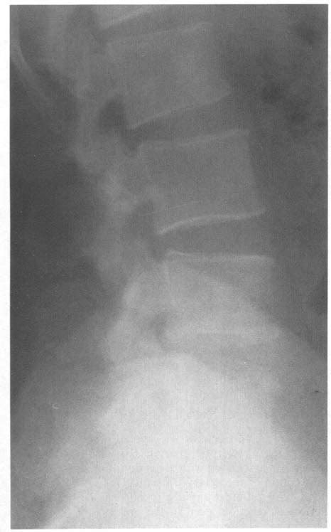 A Lateral Radiograph Of Lumbar Spine And B Anteroposterior