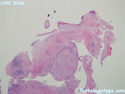 cholesteatoma ear histology