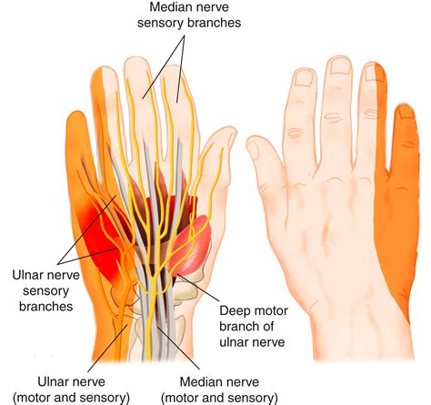 Injection Technique for Ulnar Tunnel Syndrome - Clinical Tree