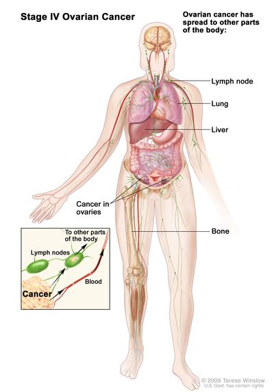 Stages Of Ovarian Epithelial Fallopian Tube And Primary Peritoneal Cancer Navigating Care