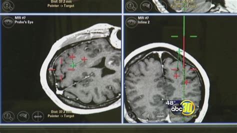 Burning Away Brain Tumors | abc30.com