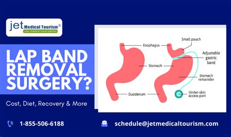 Lap Band Removal Surgery | Lap Band Removal Cost & Recovery