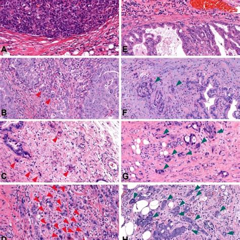 Tumor Budding And Pdc Grades Assessed According To Itbcc Download Scientific Diagram