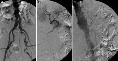 Intraoperative Fluoroscopy Imaging Of Endovascular Aaa Repair Involving