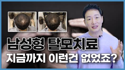 남성형 탈모치료에 효과적인 새로운 치료법 알려드립니다 Youtube