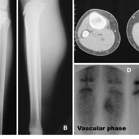 A B Anteroposterior And Lateral Radiographs Of The Patients Left Leg