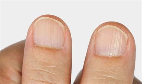 The Signs In Your Nails You Have A Vitamin Deficiency From White