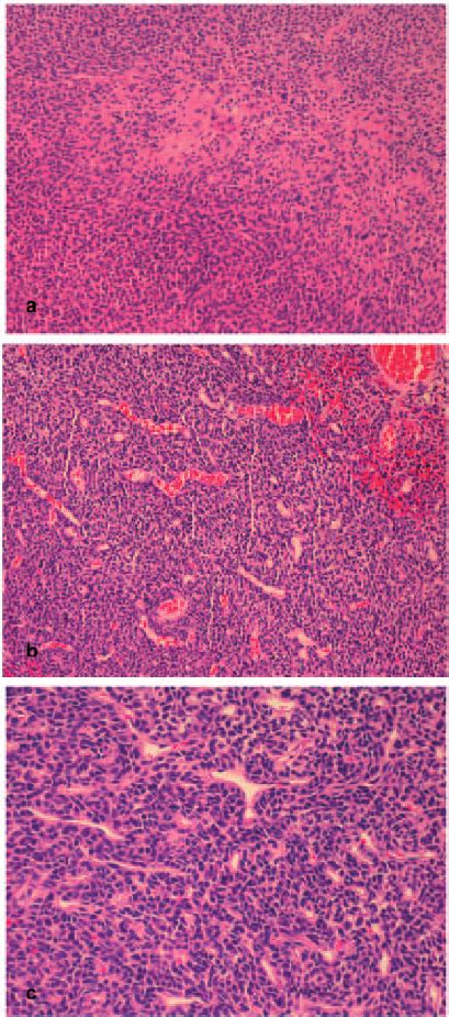 Photomicrographs Of The Tumour Showing A An Admixture Of Oval And