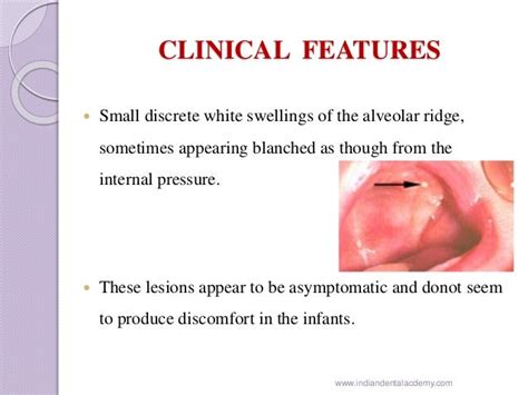 Gingival Cyst Of Newborn Orthodontic Courses By Indian Dental Academ