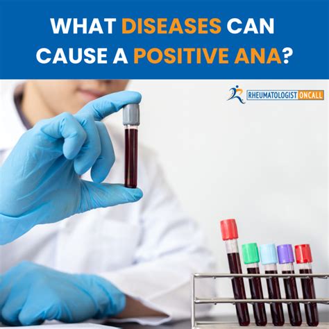 Rheumatologist Guide: What Diseases Can Cause A Positive ANA?