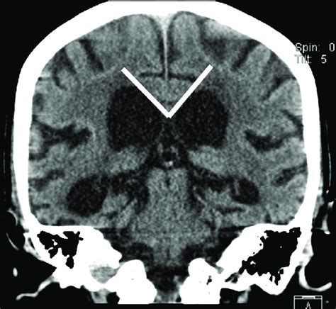 Callosal angle was defined as the angle between the lateral ventricles ...