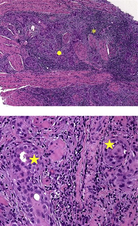 A And B Squamous Cell Carcinoma Like Nests Show Weak Keratinization Download Scientific