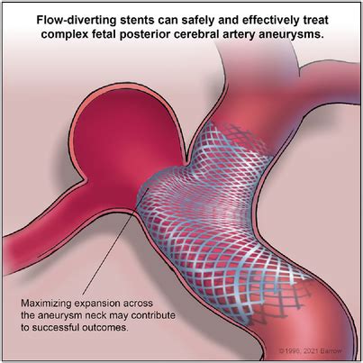 Flowdiversion For Complex Posterior Communicating Artery Aneurysms