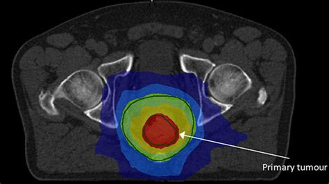 New Treatment Could Spare Early Stage Rectal Cancer Patients Life