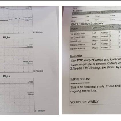 Electromyography (EMG) results of patient. | Download Scientific Diagram