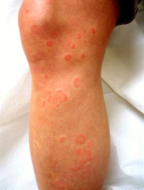 Erythema Multiforme Target Lesions