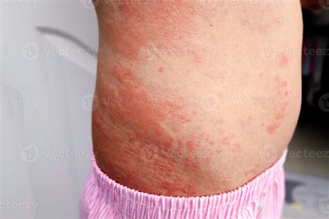 Forte Allergico Eruzioni Cutanee Su Il Corpo Alterata Immunit E