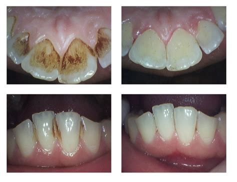 How to Prevent and Remove Coffee Stains From Your Teeth?