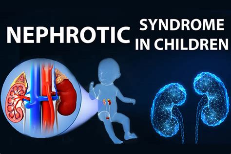 Pediatrics Nephrotic syndrome - Centre For Research - National Hospital ...