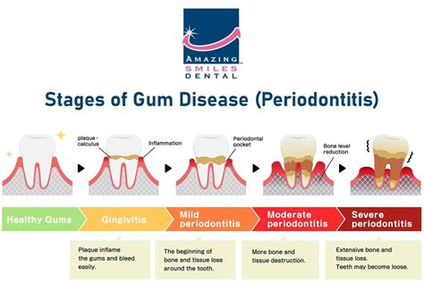 Periodontitis Gum Disease Symptoms Causes And Treatment