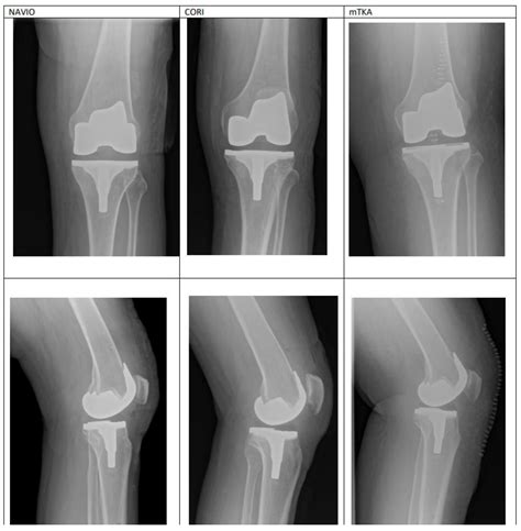 Medicina Free Full Text Robotic Assisted Total Knee Arthroplasty