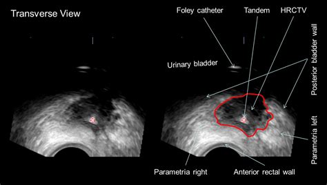 Transrectal Ultrasound For Image Guided Adaptive Brachytherapy In