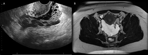 Multilocular Peritoneal Inclusion Cysts Throughout The Pelvis Journal