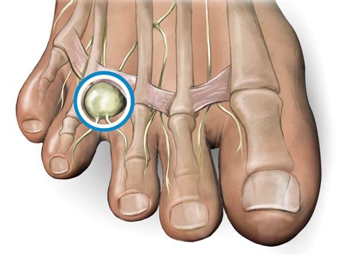 Neuroma de Morton Madrid Health Quiropráctico en Madrid