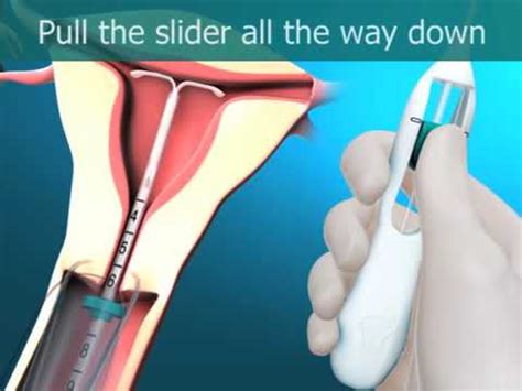 The new Mirena insertion & removal - YouTube