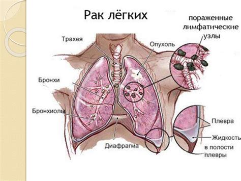 Заболевания органов дыхания. Гигиена дыхания - презентация онлайн