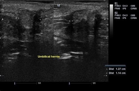 Stomach Ulcer Ultrasound