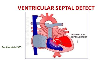 Ventricular Septal Defect Anatomy