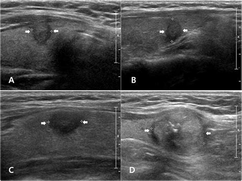 Malignant Thyroid Nodules Ultrasound