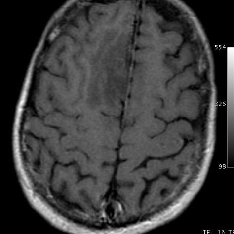 Axial T Weighted Gadolinium Enhanced Mri Showing An Area Of