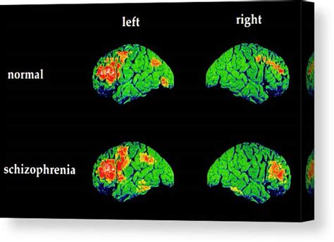 Schizophrenic Brain Compared To Normal Brain