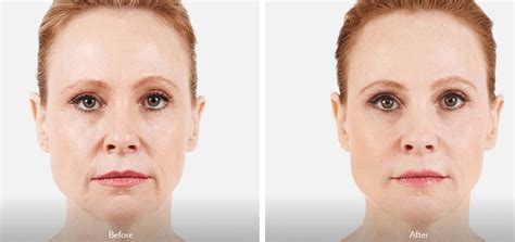 Dermal Fillers Nyc Facial Fillers New York City